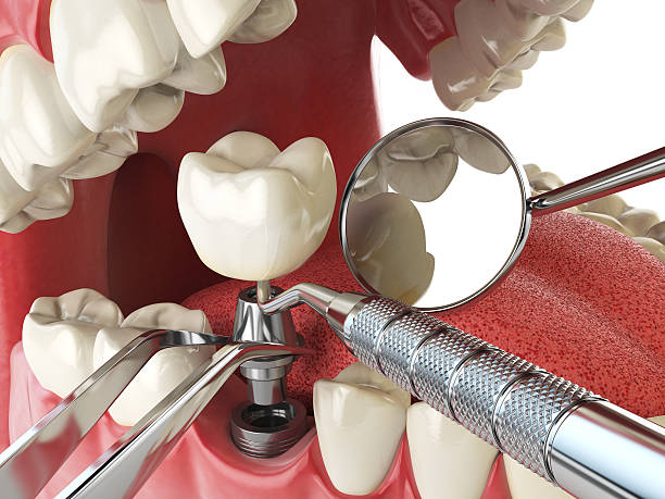 Best Dentist for Tooth Abscess  in Glassmanor, MD